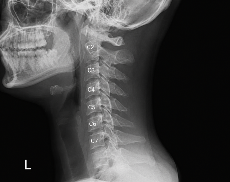 X-ray of the cervical spine showing the C2 through C7 vertebrae.